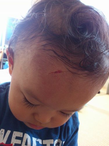 1歳児の怪我