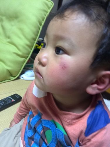 2歳児の怪我
